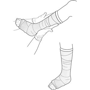 Leg Cast